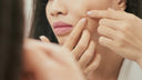 How to Get Rid of Pimples on Your Face