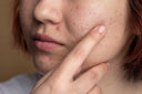 How to Take Care of Acne Prone Skin