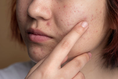 How to Take Care of Acne Prone Skin