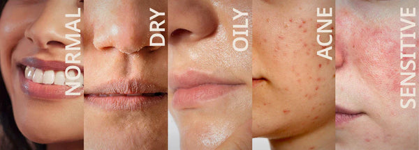 What is My Skin Type: A Complete Guide
